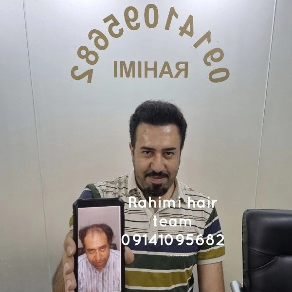 بهترین کلینیک کاشت مو در تبریز
